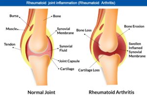 Rheumatoid joint inflammation 