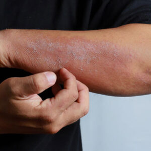Psoriasis - Skin Diseases